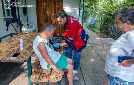 Житомирщина: горожанка в опіках через самотужне гасіння пожежі.